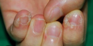 Nd YAG and pulsed dye laser have quick procedure times